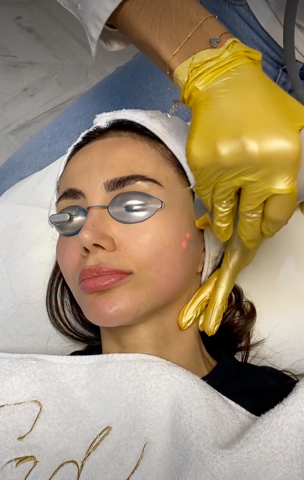 Photo facial rejuvenation (IPL), IG @sadaf_jaffari | Treatwell